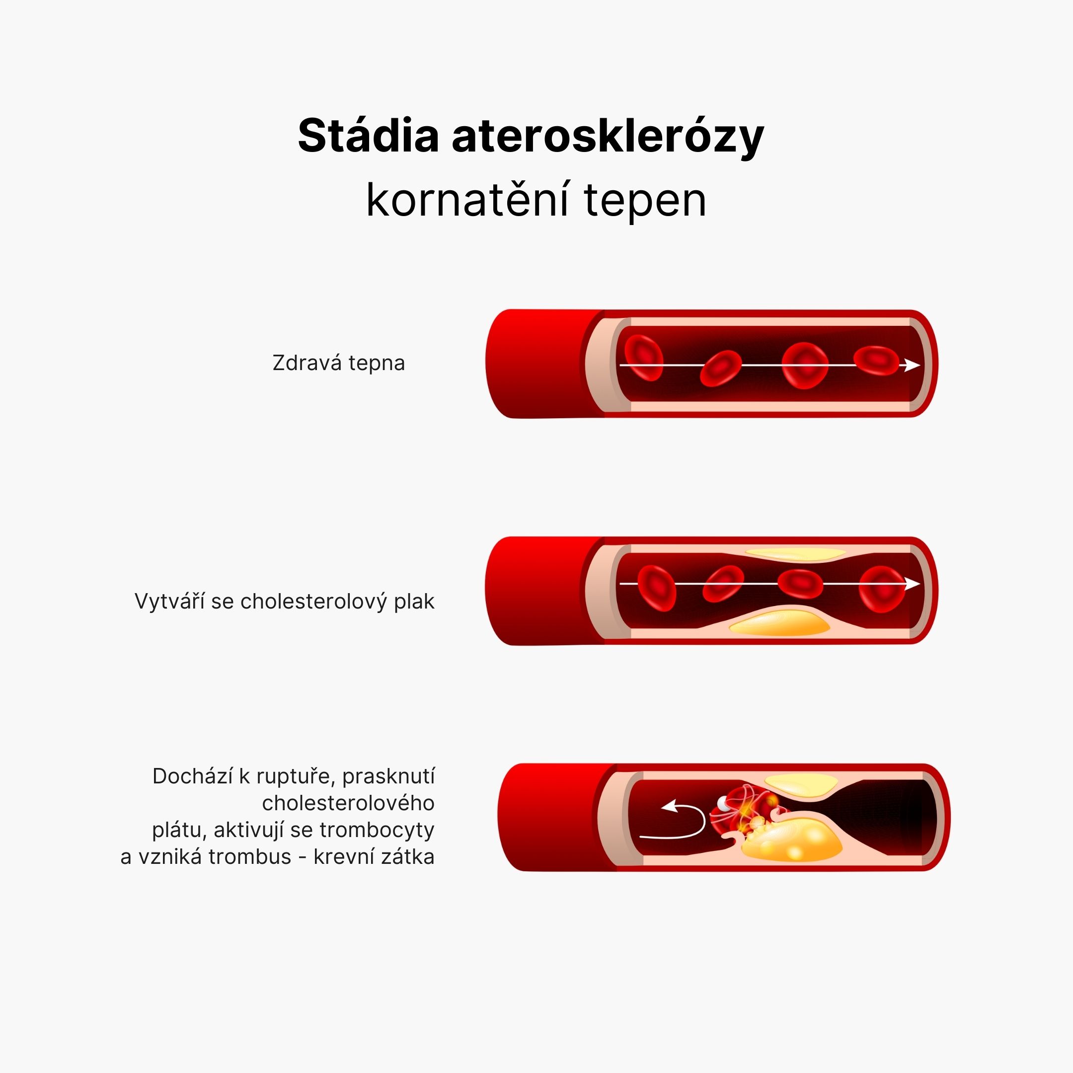 Arterioskleróza (2)